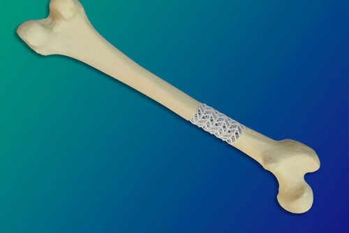 © Fraunhofer IFAM The SCABAEGO project scaffold can be customized to fit any size of long bone. With the help of a CT scan of the bone, the scaffold can be tailor-made using 3D printing.