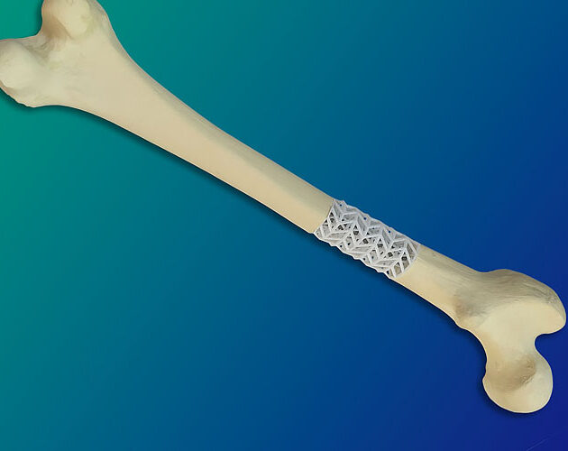 Bioactive composite supports healing of broken bones